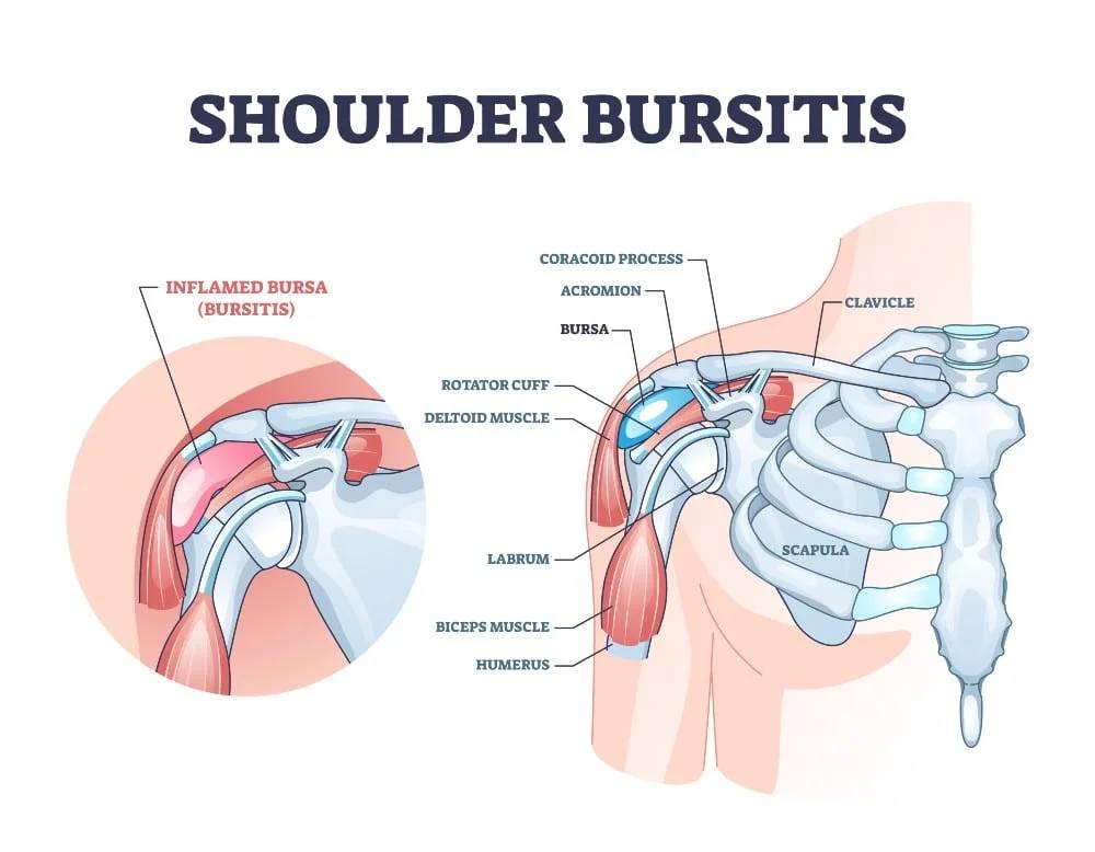 Shoulder bursitis